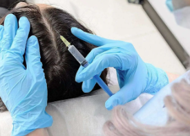 Intradermoterapia capilar: a solução ideal contra a queda de cabelo crônica
