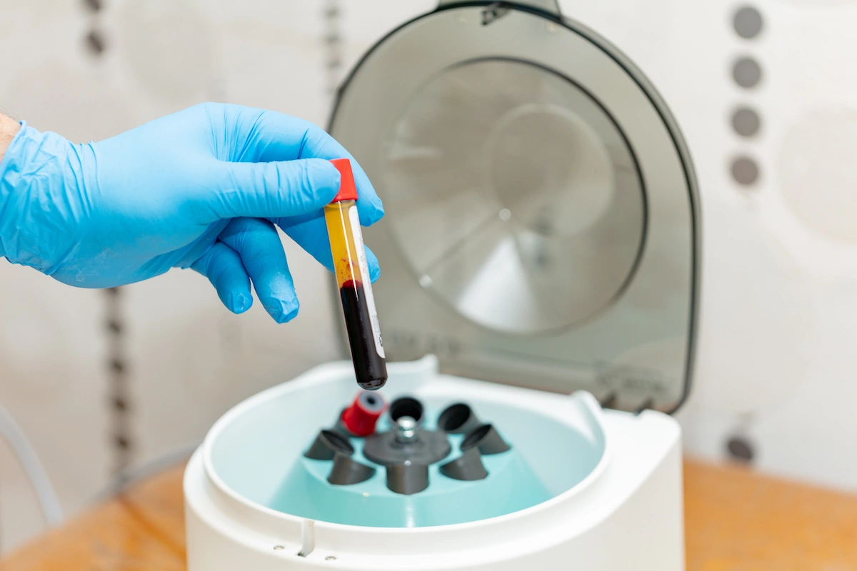 Tratamento PRP: a tecnologia avançada que está revolucionando a recuperação muscular