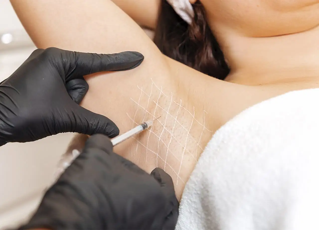 Botox na axila: como o tratamento diminui a produção excessiva de suor
