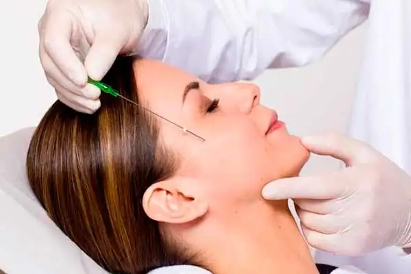 O que são fios de sustentação e como eles rejuvenescem o rosto