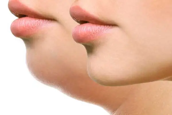 Lipo Enzimática de Papada Lipo Enzimática de Papada